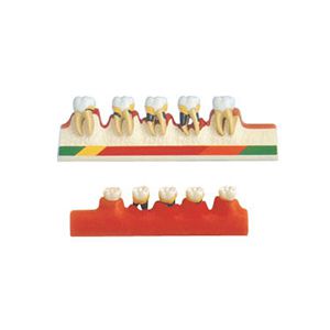 Periodontal disease classification model